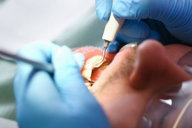 Best Dental Abscess Treatment in Harlem Heights, FL